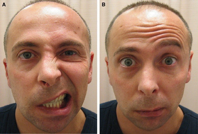 Facial Nerve Paralysis Rehabilitation 2 1 s2.0 S0196064404018050 gr1