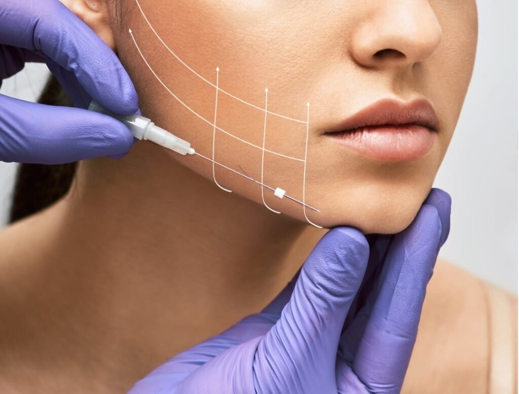 facial lifting thread thread facelift with arrows on face for womans skin procedure facial.jpg s1024x1024wisk20cMCMRWWZ0ghADNXX9HHsCbxawMV83qLj9kJn0gpQVZZc 1