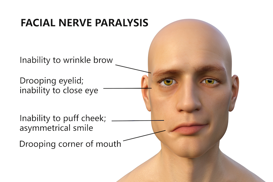 Facial Nerve Paralysis Rehabilitation 1 facialnerveparalysiscopy