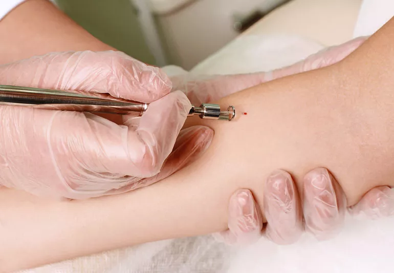 Therapeutic Care 5 skinCancerRemoval 942188268 770x533 1 jpg