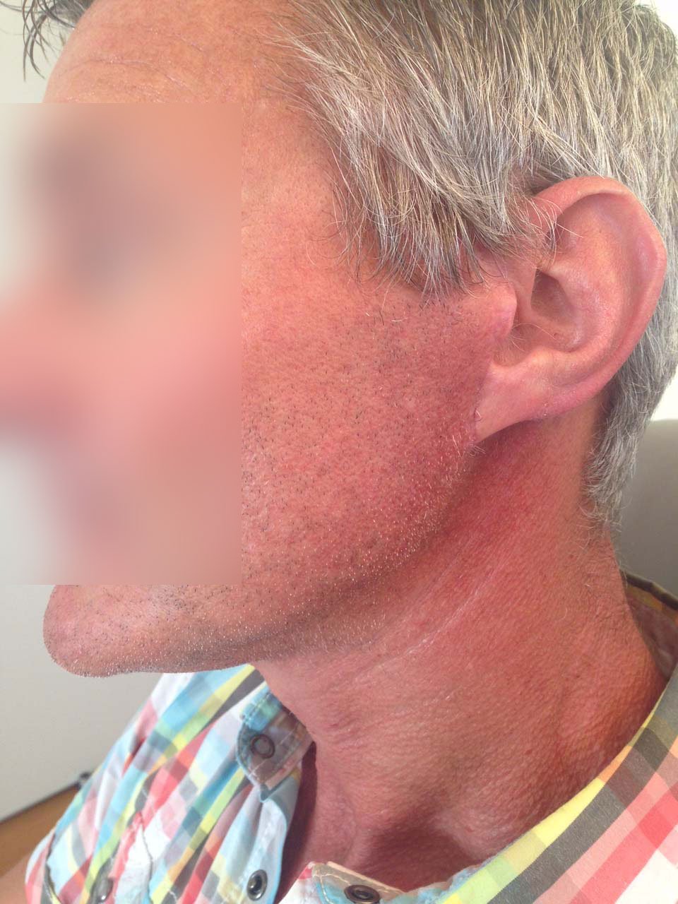 Facial Symmetry Surgery 9 CAS 5 profil large