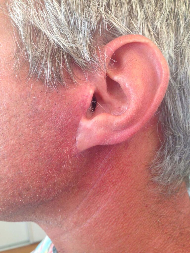 Facial Symmetry Surgery 15 Cas 5 profil rapproche