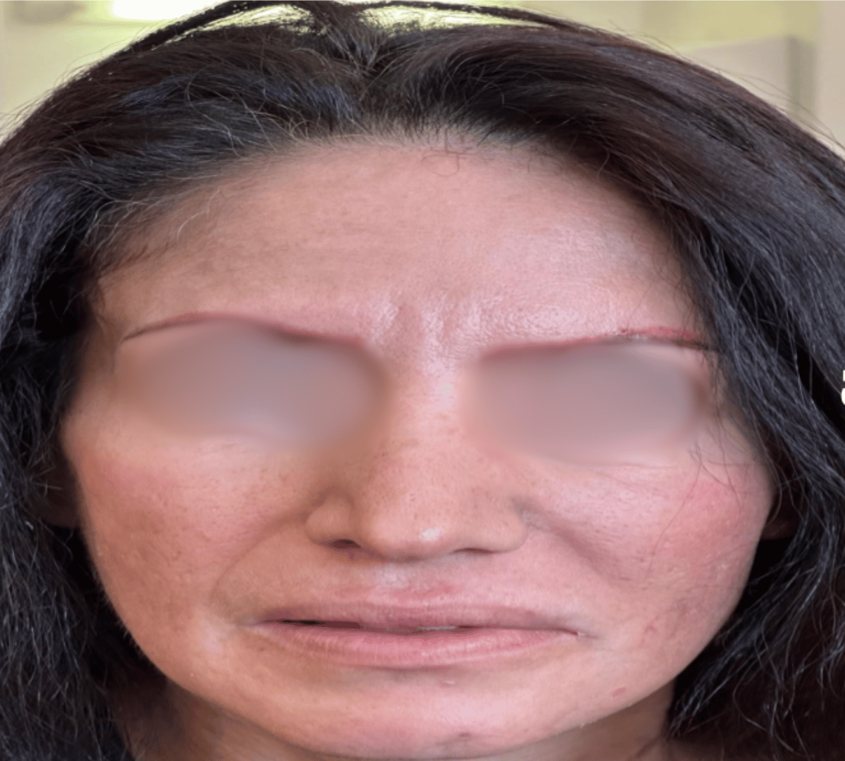 Facial Palsy Rehabilitation 9 FP Post1
