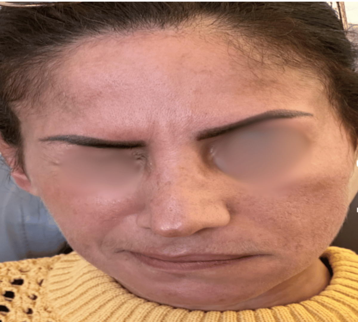 Facial Palsy Rehabilitation 8 FP Pre1