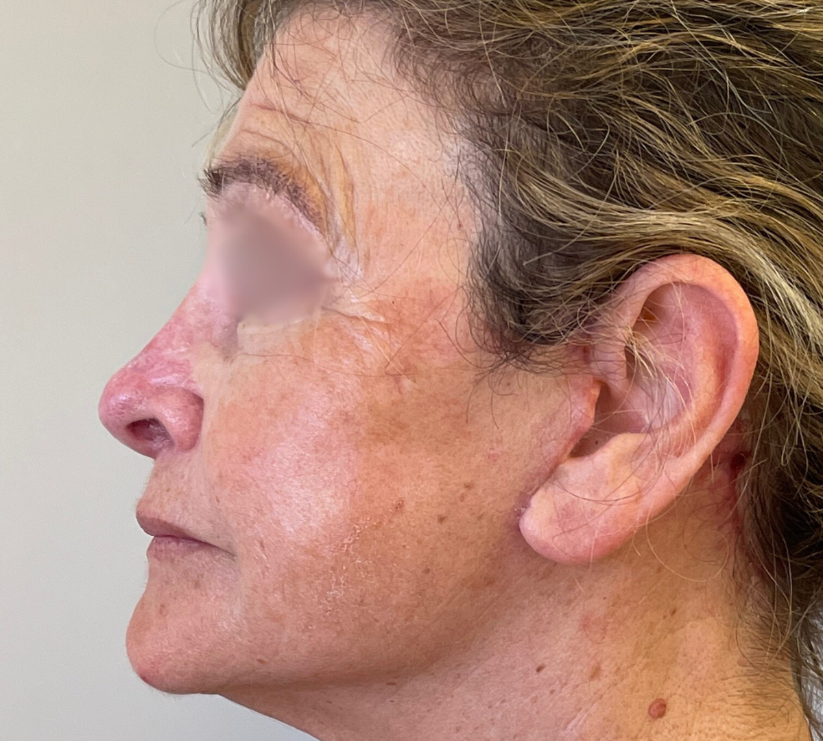 Facelift Surgery 4 Facelift Post 1