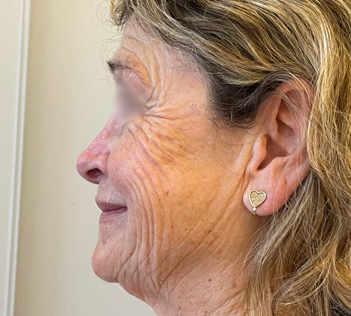 Facelift Surgery 3 Facelift Pre1
