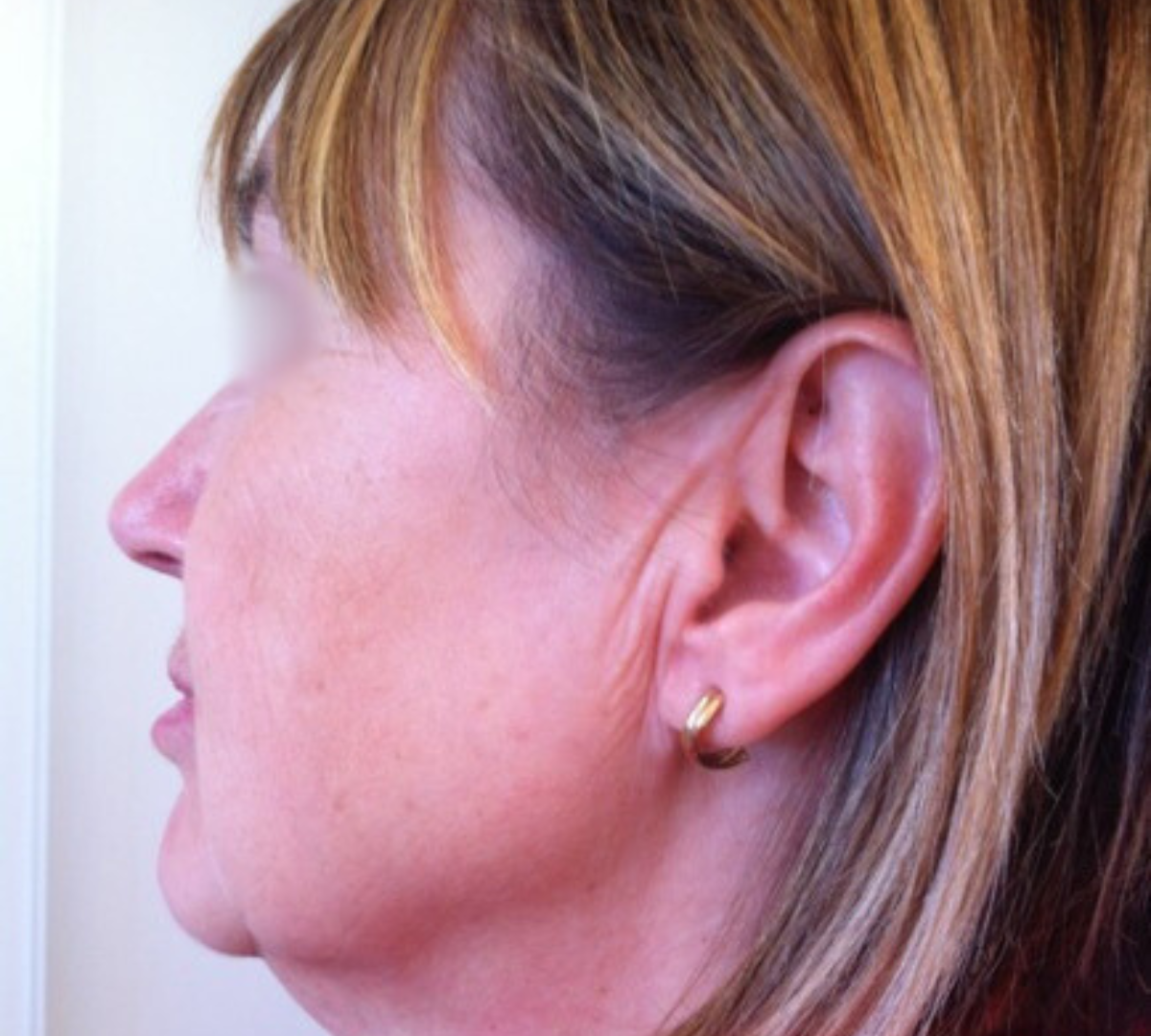 Facelift Surgery 5 Facelift Pre2