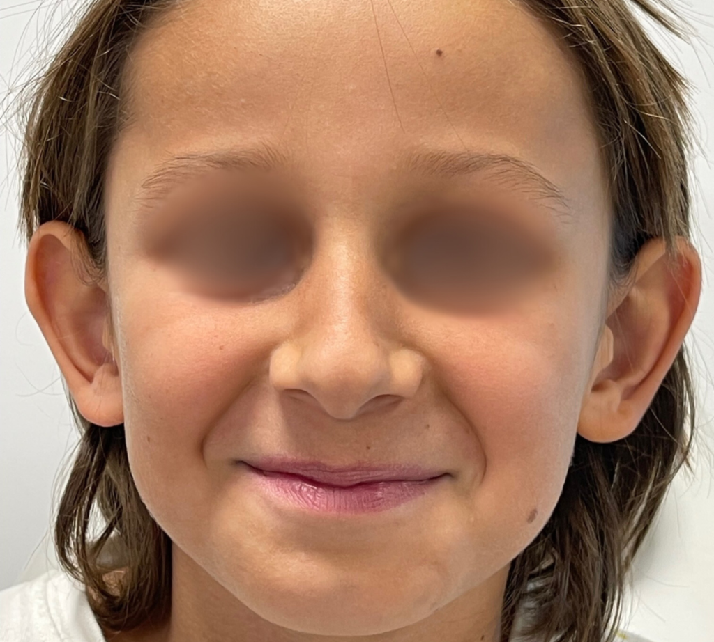 Pinnaplasty (Ear Surgery) 9 PPre1