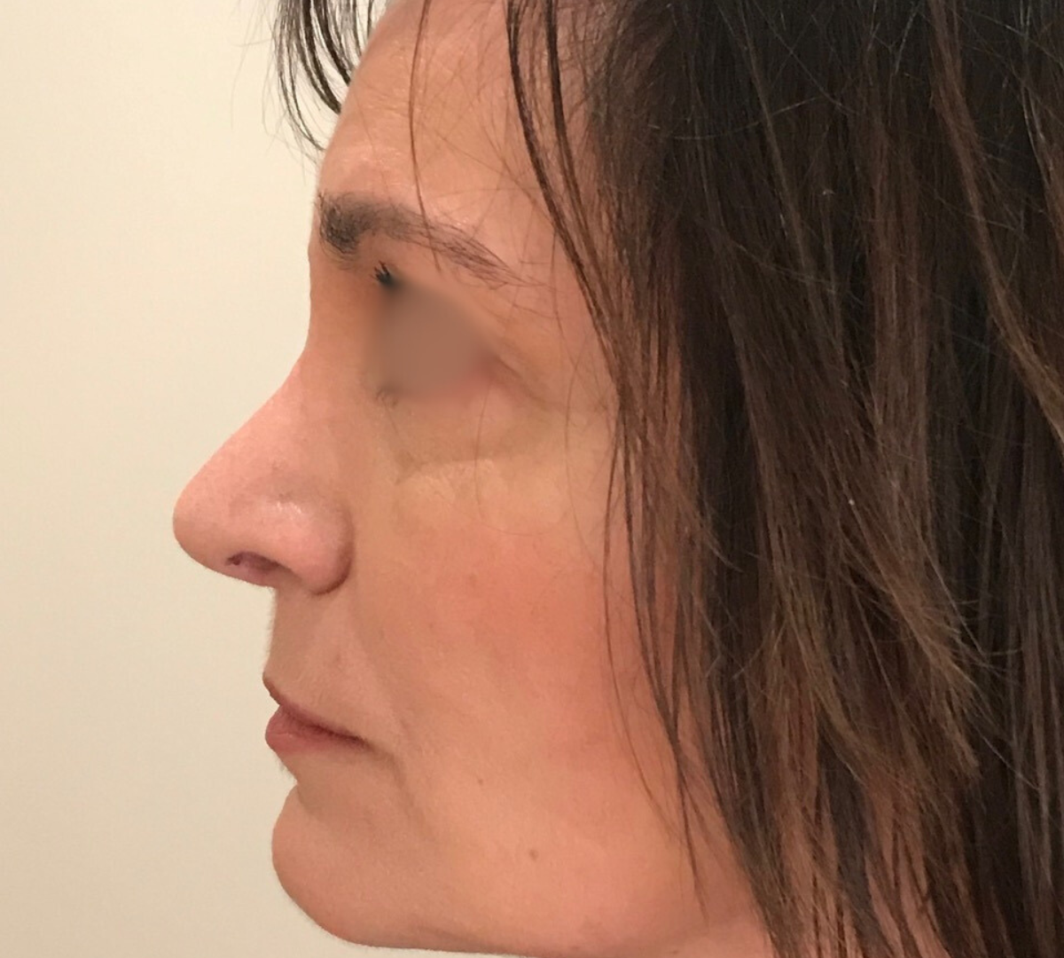 Rhinoplasty 8 RPlasty Post16