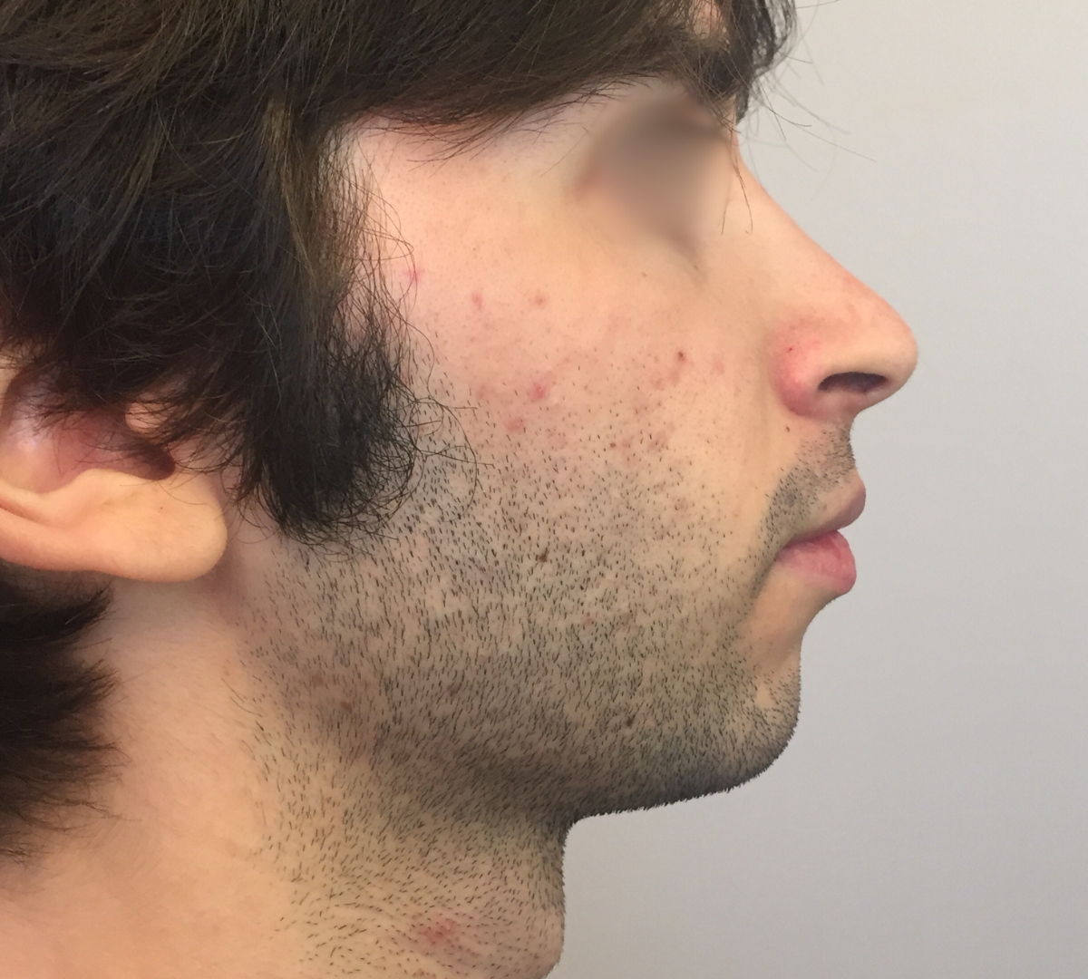 Rhinoplasty 6 RPlasty Post43