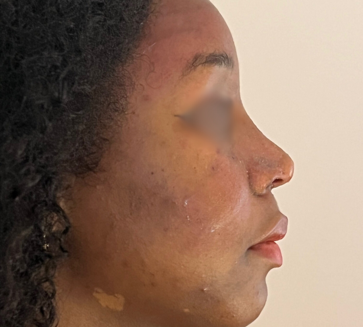Rhinoplasty 10 RPlasty Post47