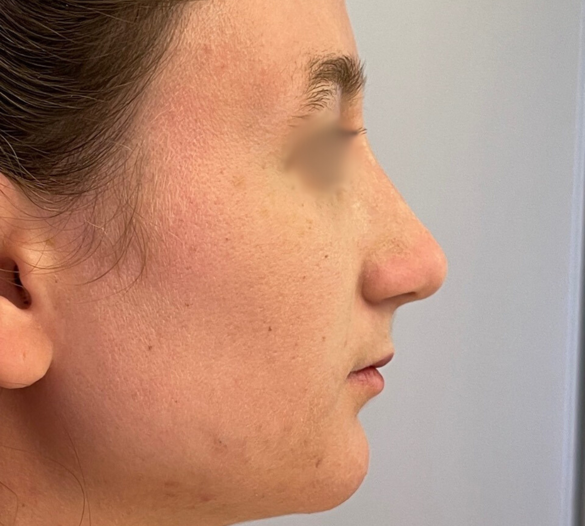 Rhinoplasty 4 RPlasty Post6