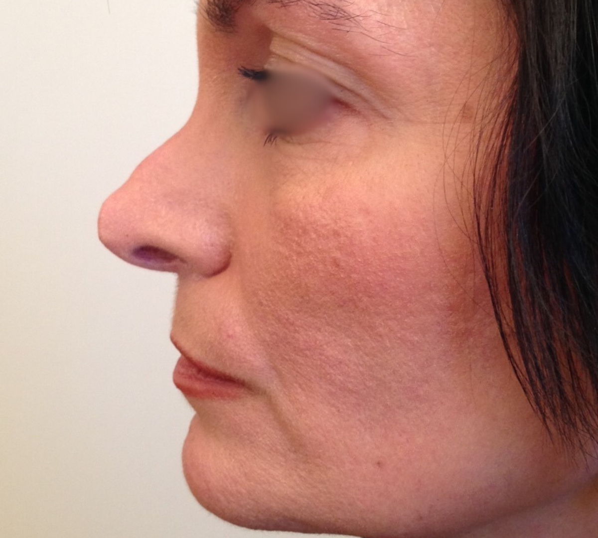 Rhinoplasty 7 RPlasty Pre16