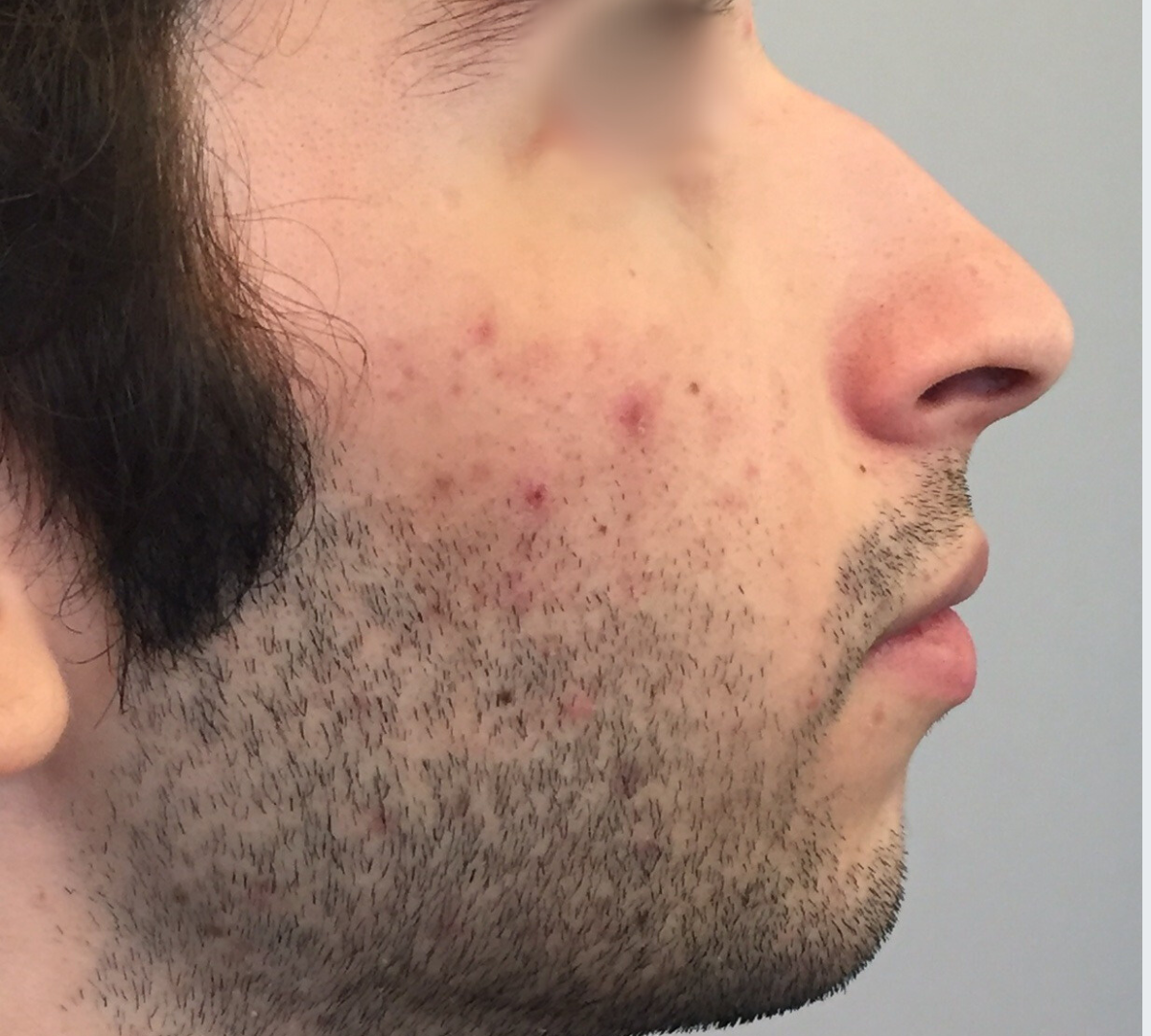 Rhinoplasty 5 RPlasty Pre43