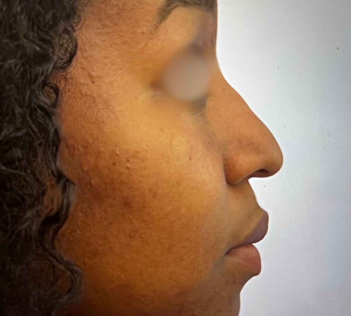 Rhinoplasty 9 RPlasty Pre47