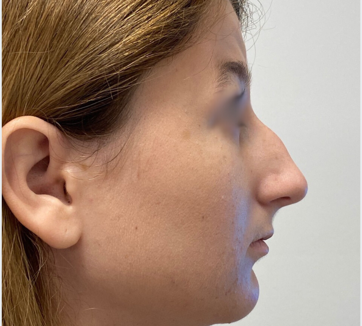 Rhinoplasty 3 RPlasty Pre6