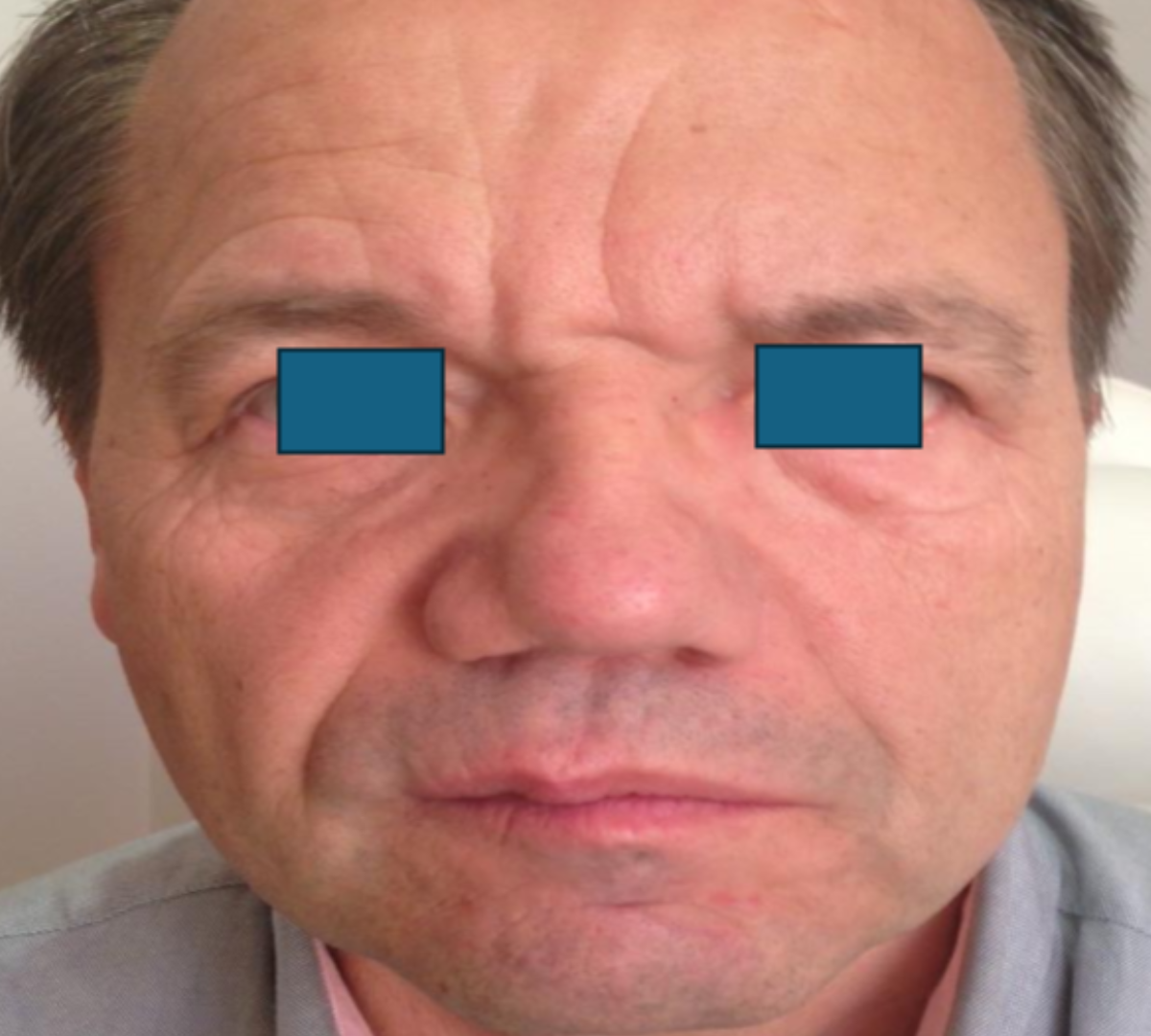 Facial Palsy Rehabilitation 1 facial post 1 1