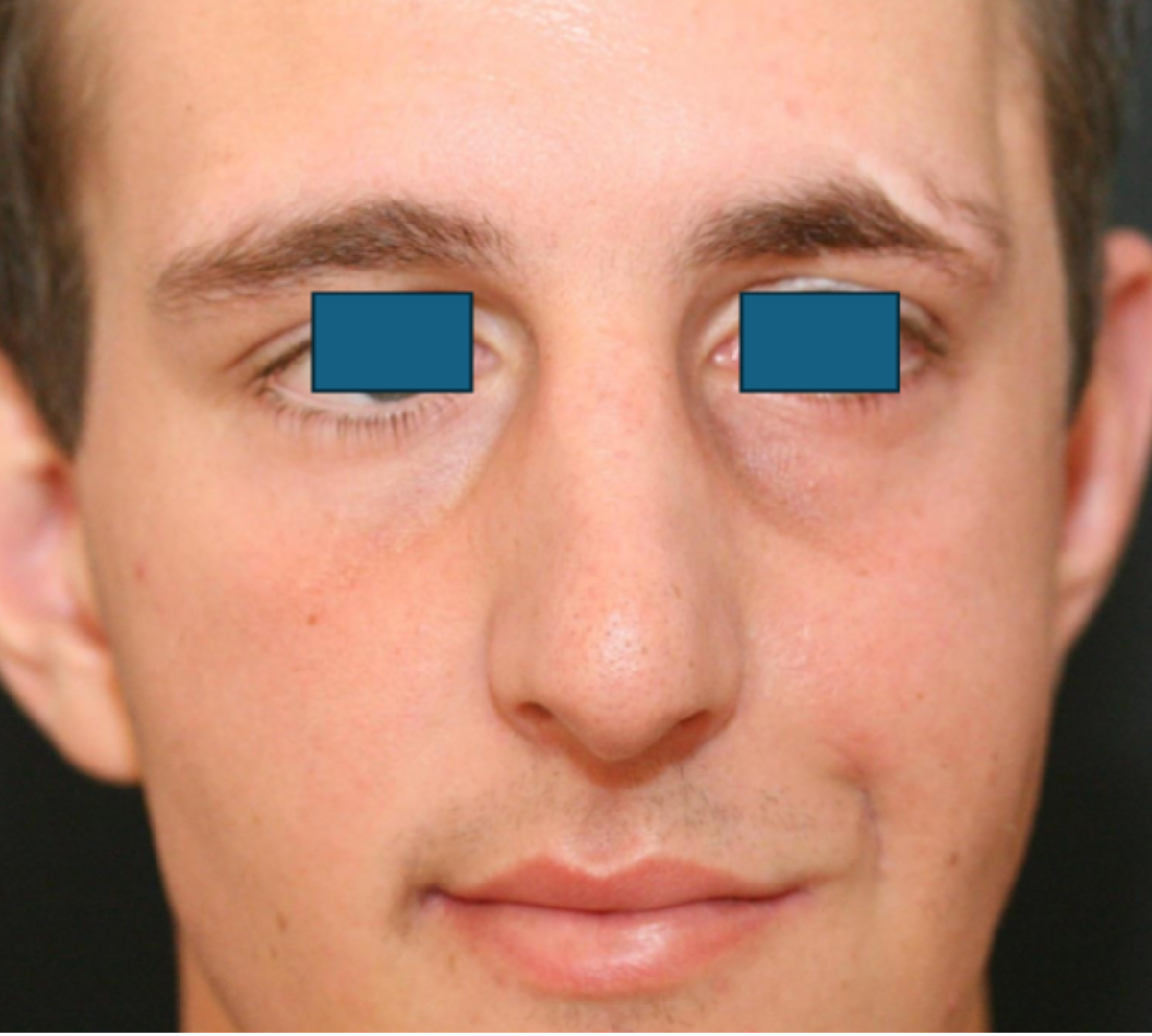 Facial Palsy Rehabilitation 3 facial post 2