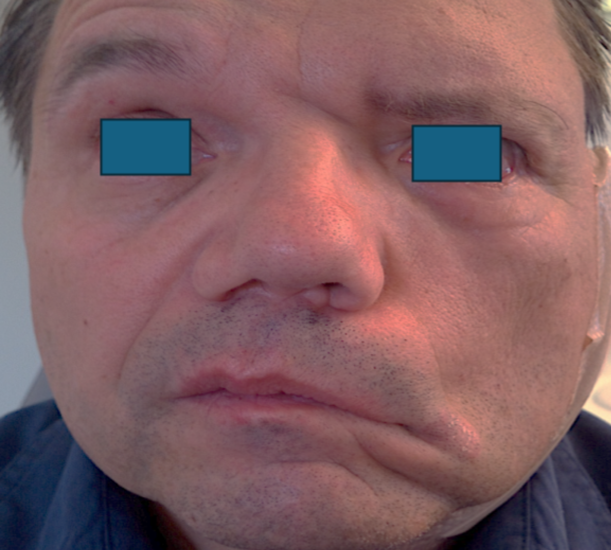 Facial Palsy Rehabilitation 2 facial pre 1 1