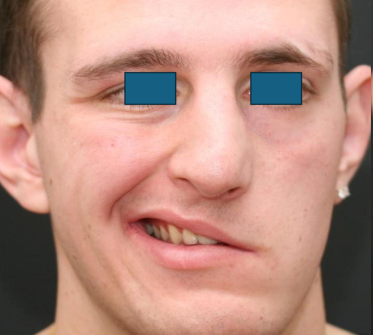 Facial Palsy Rehabilitation 4 facial pre 2