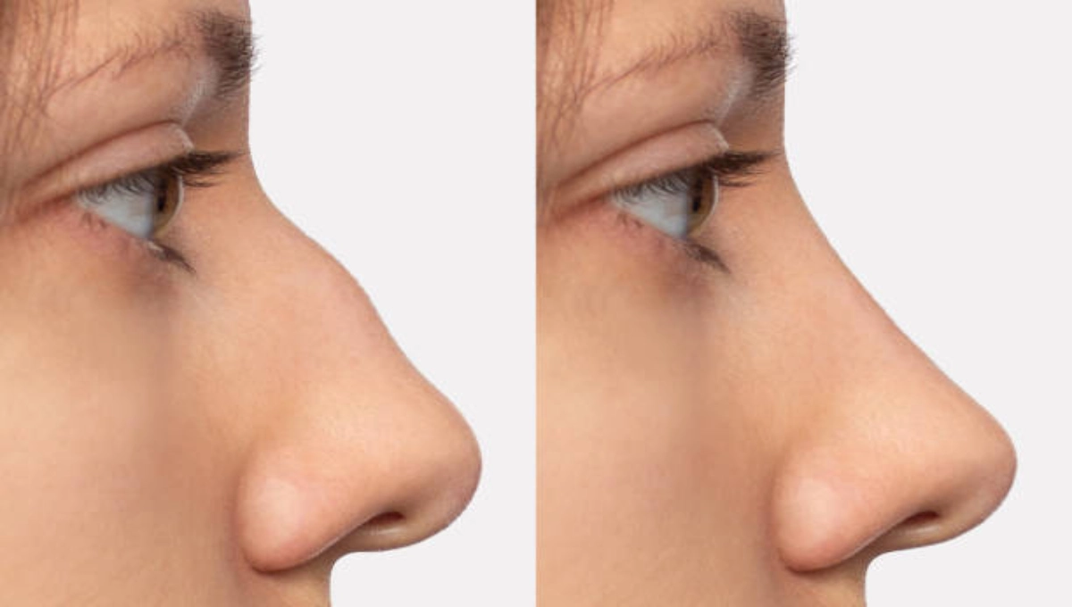 Understanding Ethnic Rhinoplasty: Preserving Natural Features