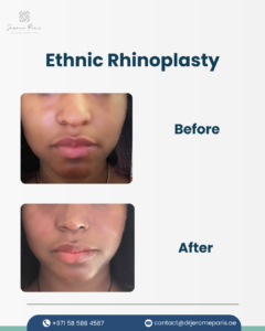 Understanding Ethnic Rhinoplasty: Preserving Natural Features 1 ethnic rhinolpasty before and after