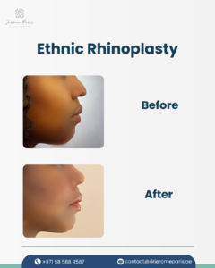 Understanding Ethnic Rhinoplasty: Preserving Natural Features 2 ethnic rhinoplasty before and after by dr jerome