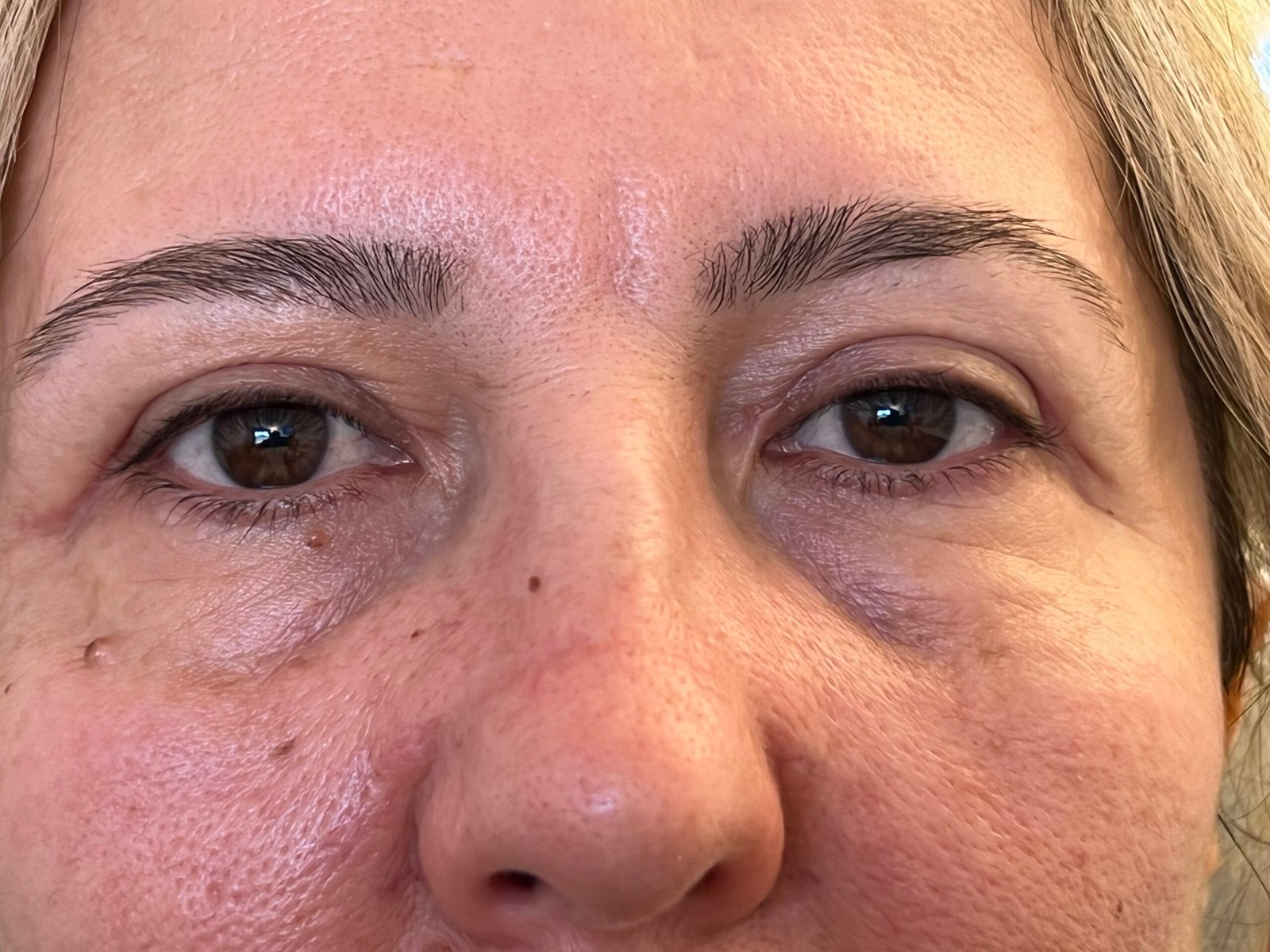 Eyelid Surgery (Blepharoplasty) 2 bleph 1 after scaled