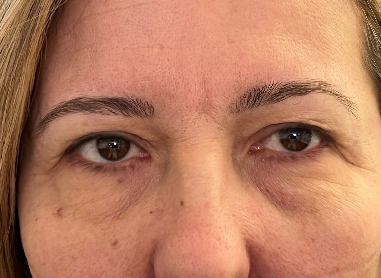 Eyelid Surgery (Blepharoplasty) 1 bleph 1 before