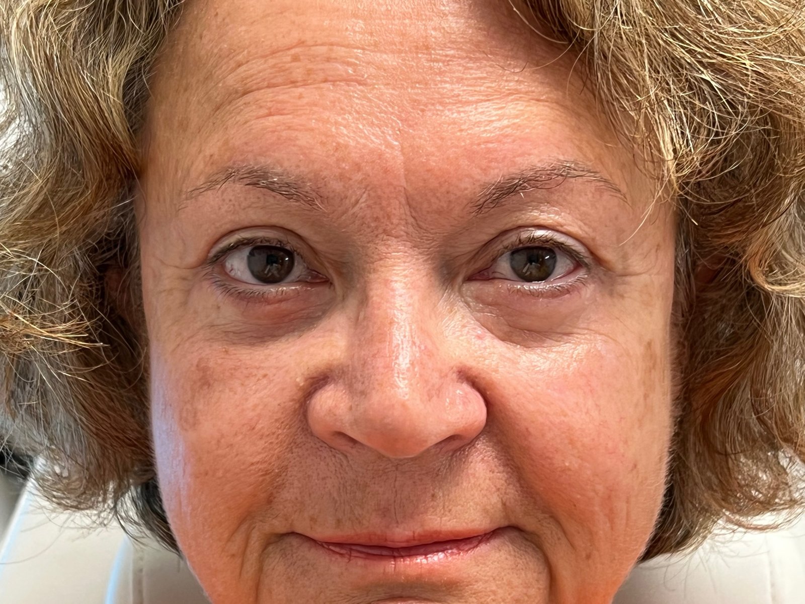 Eyelid Surgery (Blepharoplasty) 4 bleph2 after