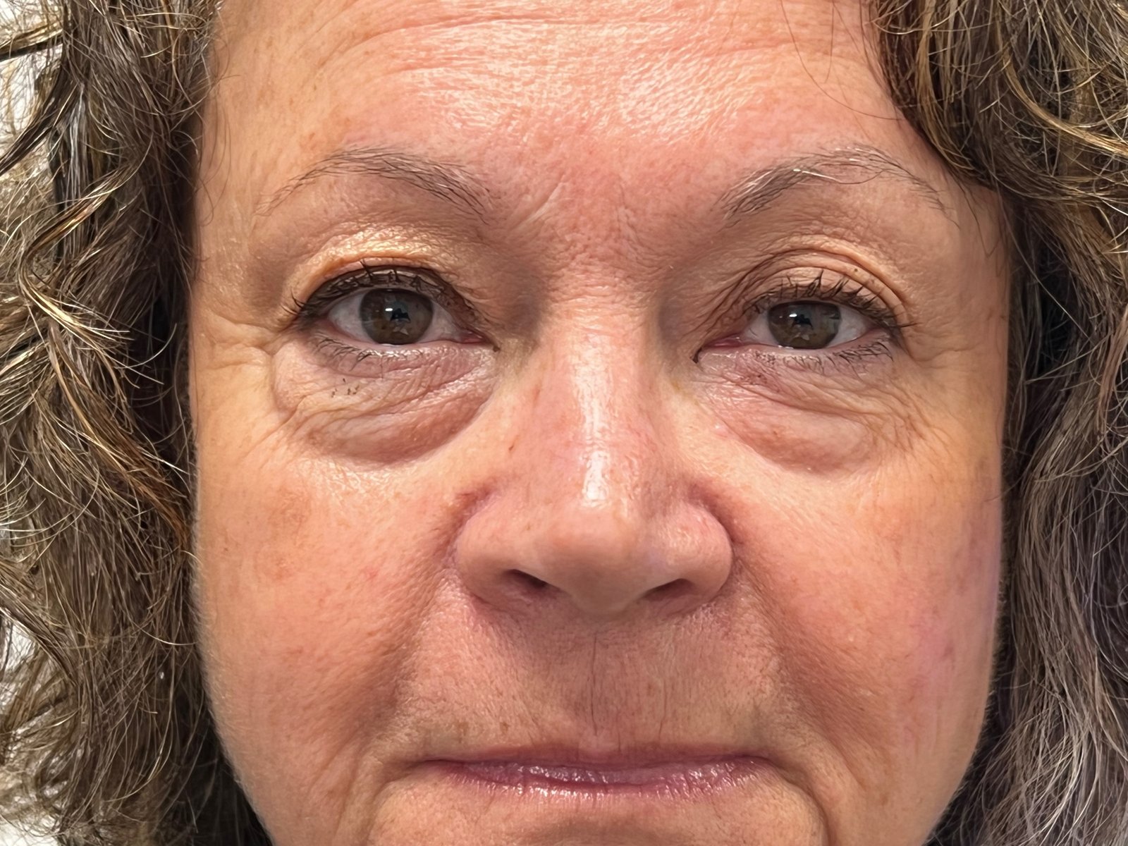 Eyelid Surgery (Blepharoplasty) 3 bleph2 before