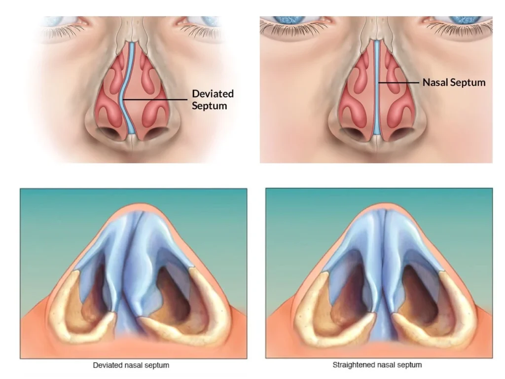 Septoplasty and Rhinoplasty for Better Breathing Results 1 Improve your airway and aesthetics. Learn how expert septoplasty and rhinoplasty in Dubai provide better breathing results for a healthier life.