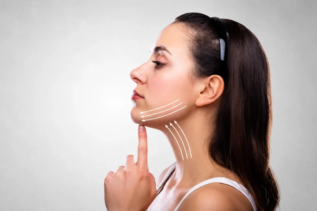 Face Surgery in Dubai: 7 Popular Procedures That Can Enhance Facial Balance 3 Profile view of a woman with white directional arrows drawn along her neck and jawline, illustrating pre-operative planning for a neck lift and jawline contouring surgery in Dubai.