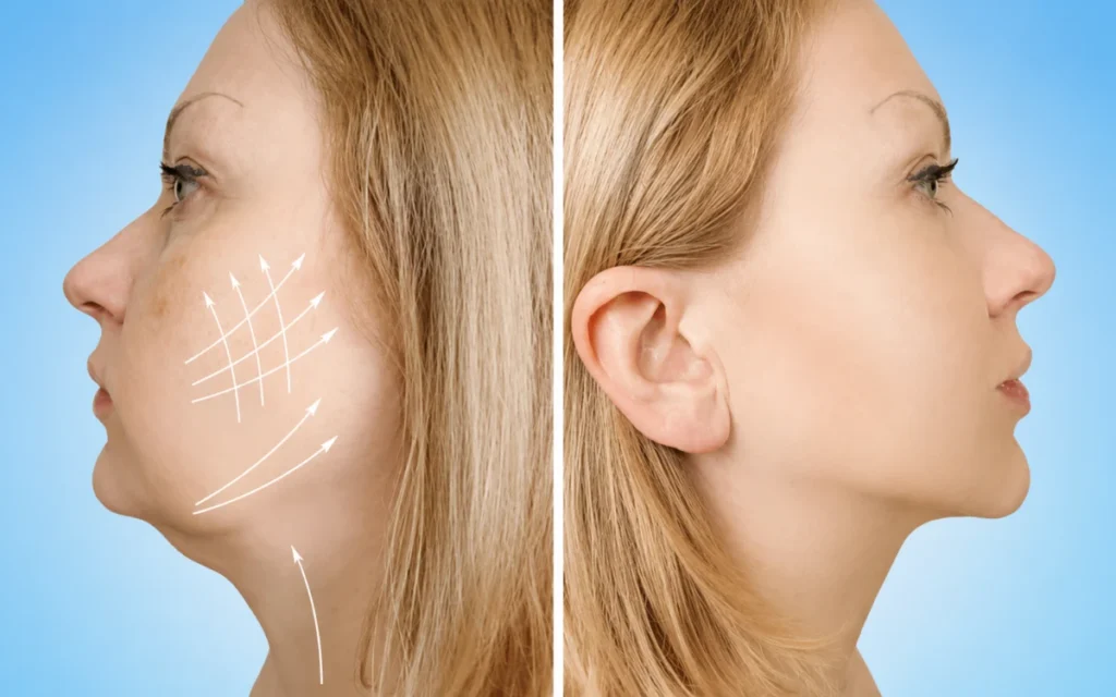 Deep Plane Facelift vs Traditional Facelift: What’s the Difference? 2 Facelift before and after showing improved jawline and facial contour