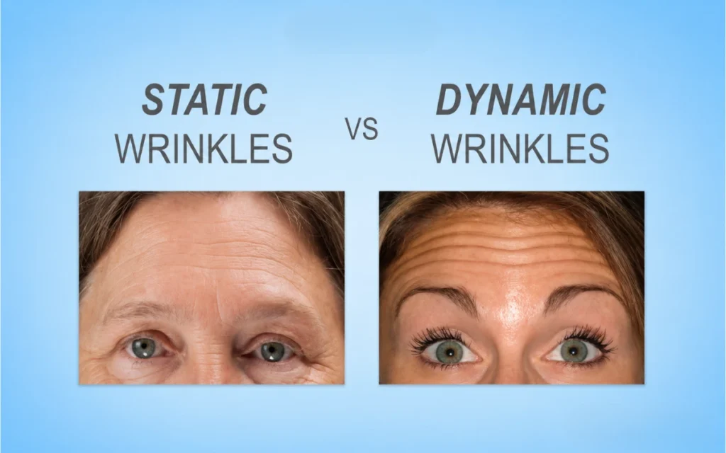 Preventative Botox: Is Starting in Your 20s or 30s Worth It? 1 Comparison of static and dynamic wrinkles on the forehead